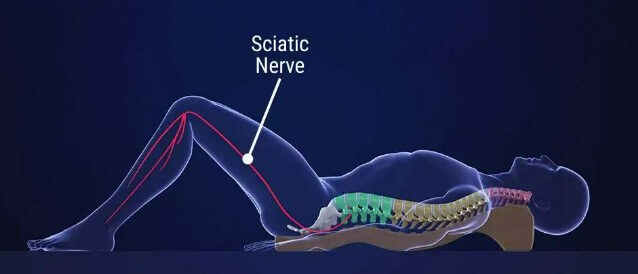 What Causes Sciatic Nerve Pain, FMPM